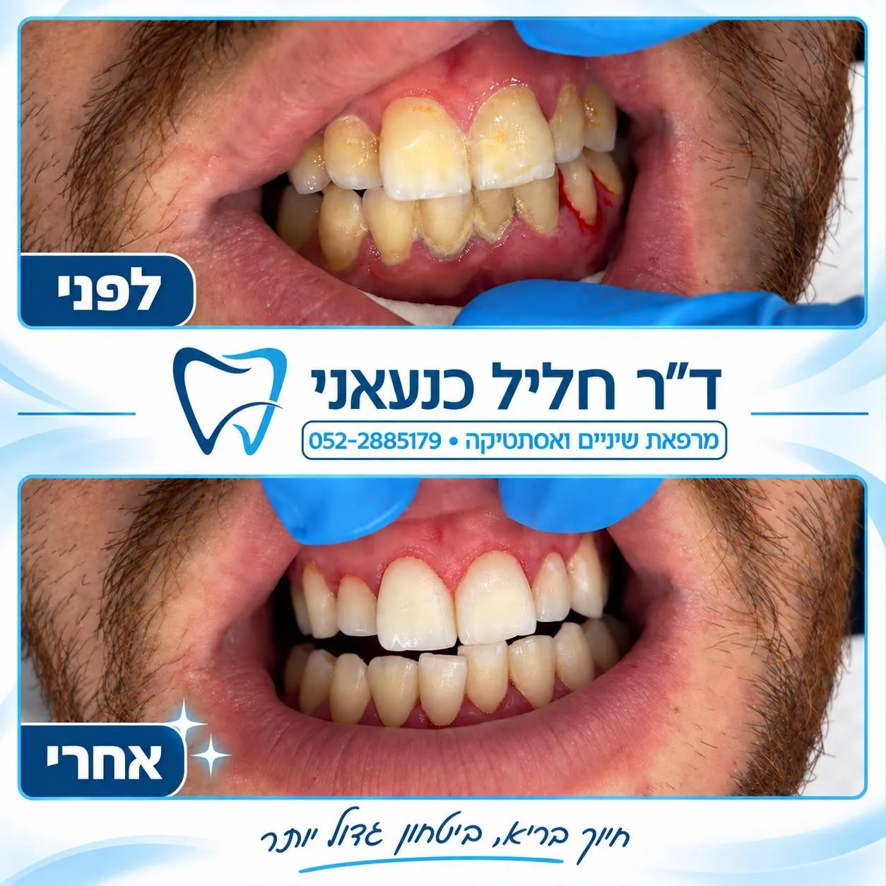 פרסום של המרפאה עם שתי תמונות של השיניים והחניכיים, מסומנות לפני ואחרי ניקוי