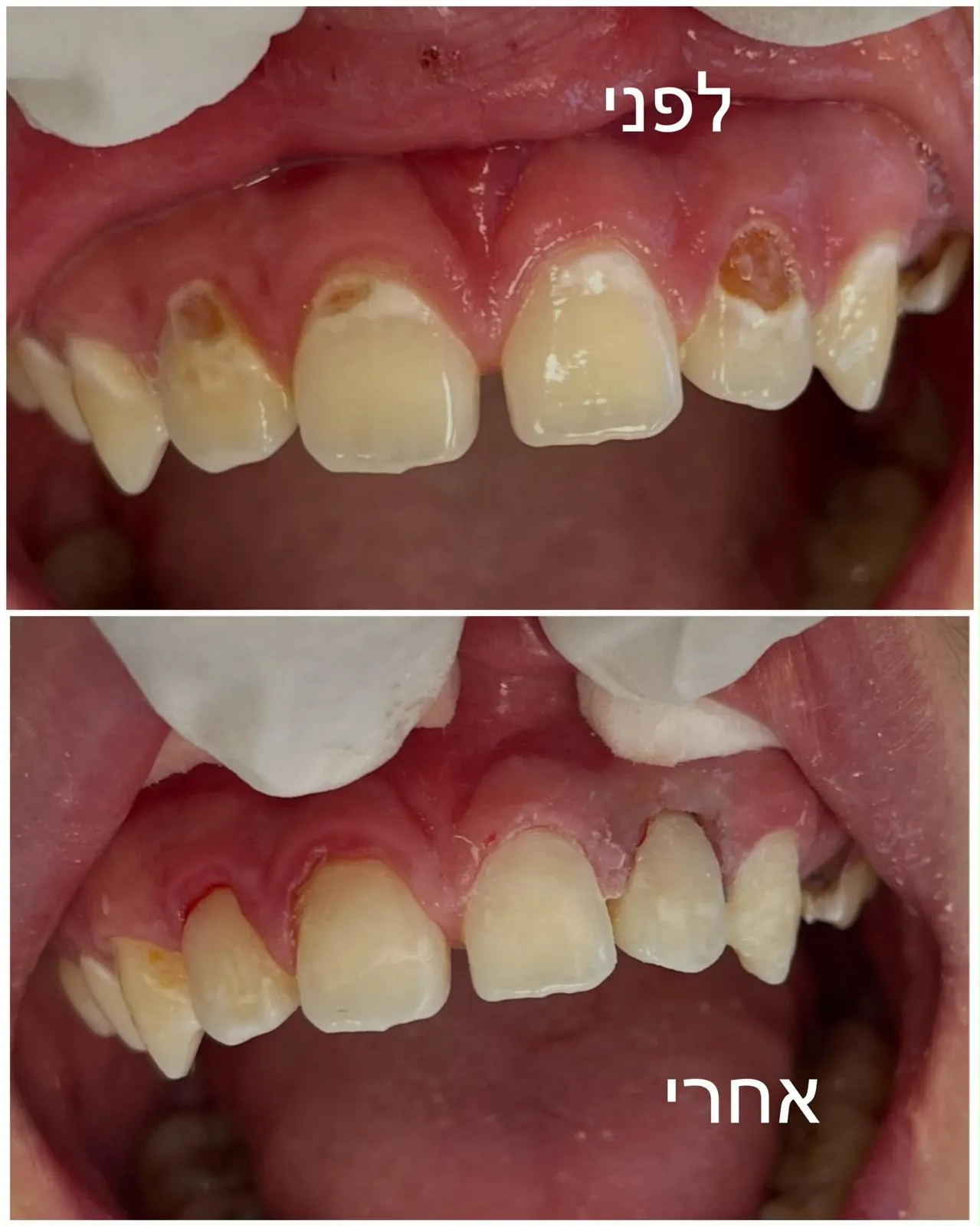 שתי תמונות של השיניים הקדמיות העליונות, מסומנות לפני ואחרי