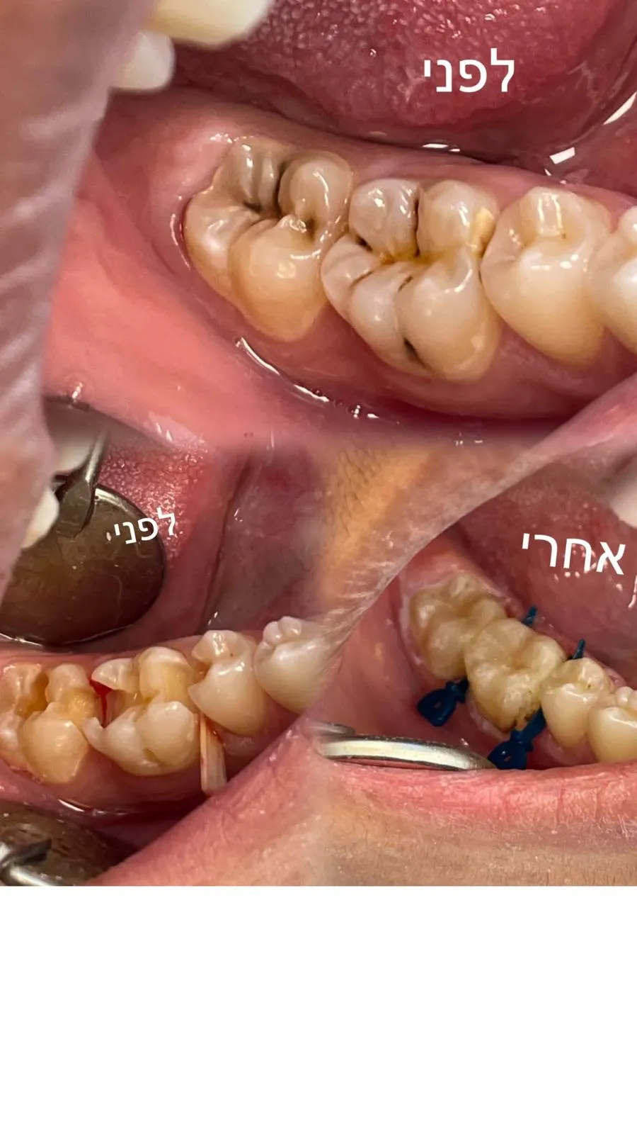 שלוש תמונות של שיניים טוחנות מזוויות שונות, מסומנות לפני ואחרי