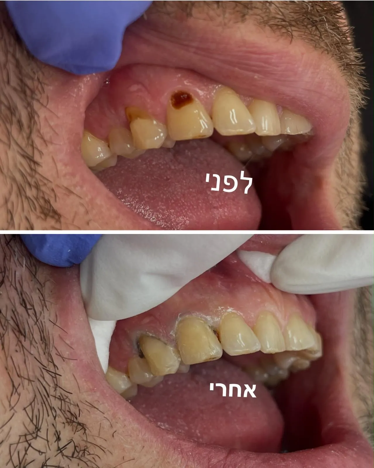 שתי תמונות של השיניים העליונות, מסומנות לפני ואחרי