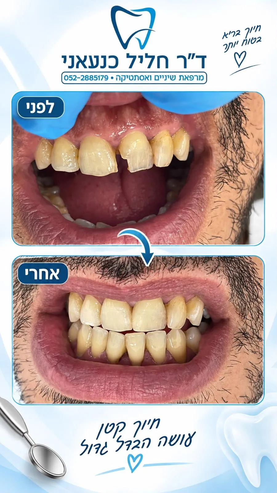פרסום של המרפאה עם שתי תמונות של השיניים הקדמיות, מסומנות לפני ואחרי