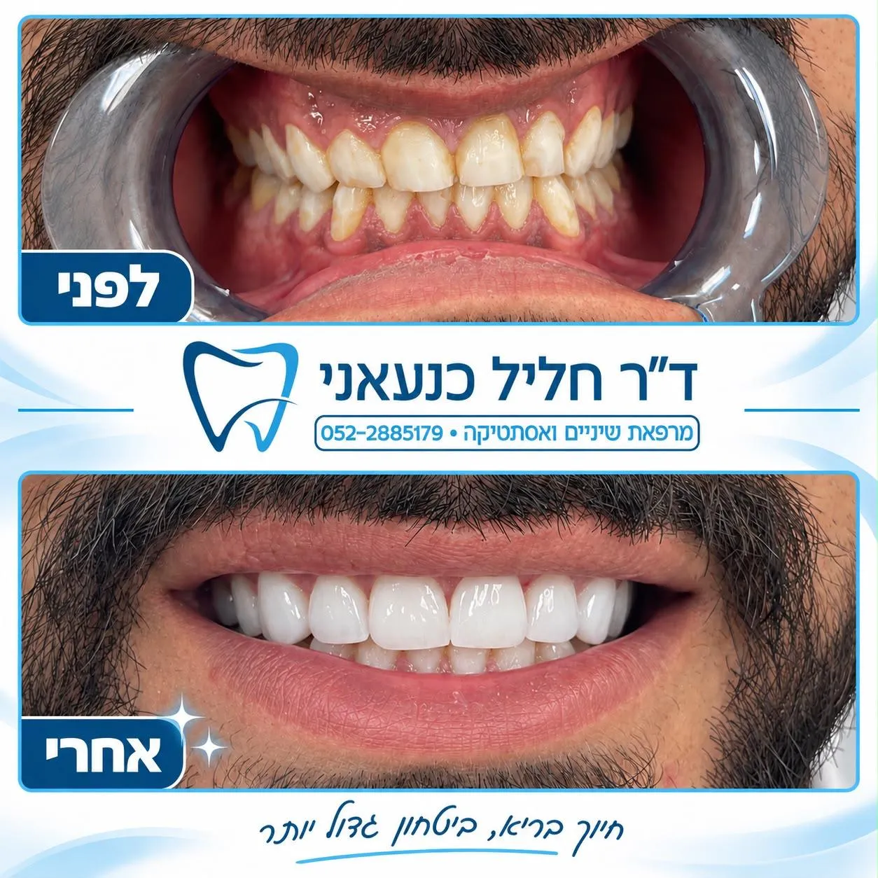 פרסום של המרפאה עם שתי תמונות של השיניים הקדמיות, מסומנות לפני ואחרי
